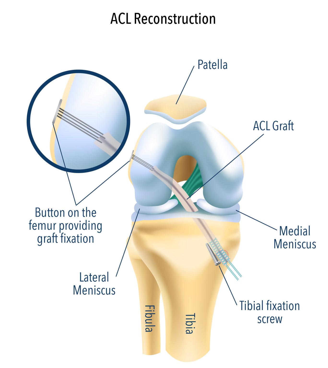 ACL Reconstruction - LIFECARE HOSPITAL